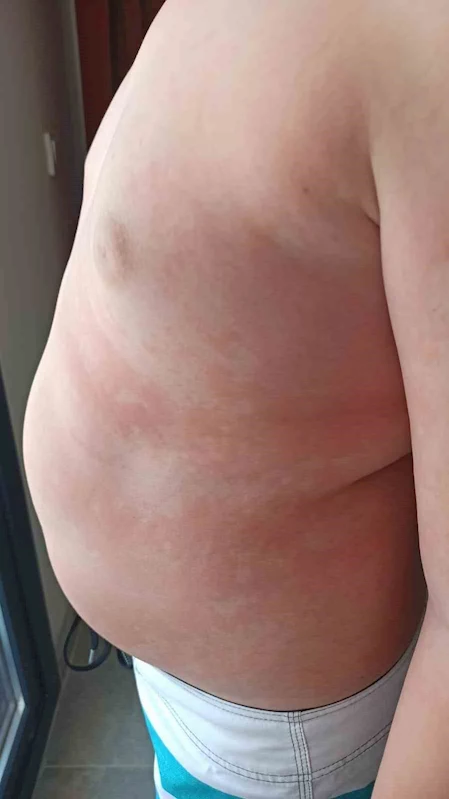 Çocuklarda besin alerjilerine dikkat: 